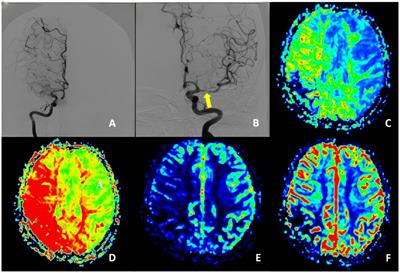 Vascular architecture characters and risk factors analysis of unstable moyamoya disease